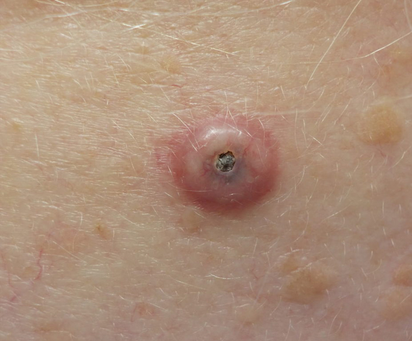 fractional laser