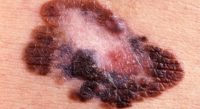 fractional laser