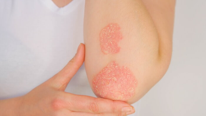 neurodermatitis